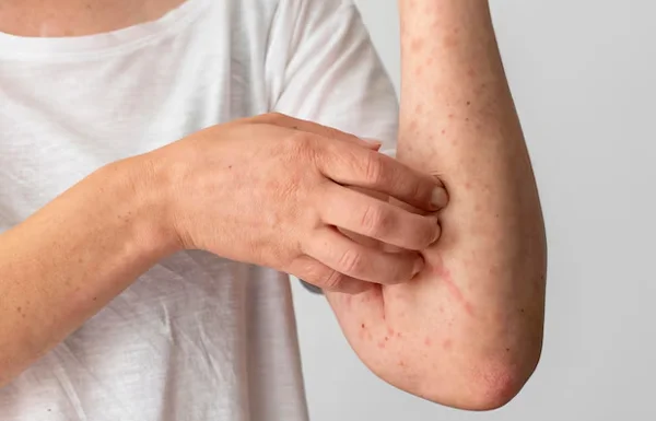 Skin Disorders